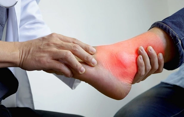 Nước chanh có giúp giảm axit uric không? BS Bệnh viện Bạch Mai giải đáp Nước chanh có giúp giảm axit uric không? BS Bệnh viện Bạch Mai giải đáp