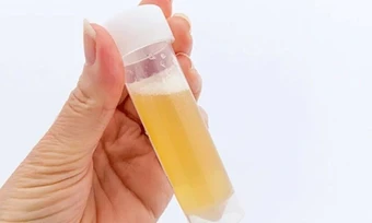 Nước tiểu có bọt như bia cảnh báo thận suy yếu