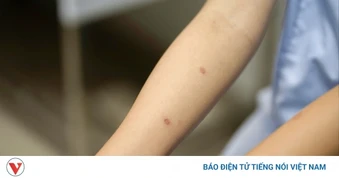 Ôm mèo mỗi ngày, bé gái 14 tuổi trả giá vì nấm da lan rộng