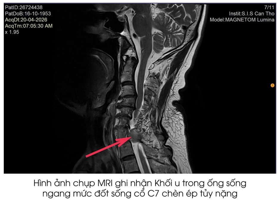 Ông lão bị bệnh hiếm gặp dễ bị nhầm lẫn và bỏ sót