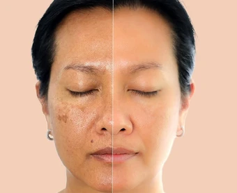 Oxy cao áp: Khi nào dùng để làm đẹp, chống lão hóa và kiểm soát bệnh chuyển hóa?