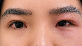 Phân biệt viêm kết mạc do virus và vi khuẩn - Báo TinVina
