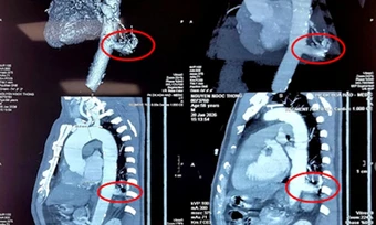 Phần 'phổi thừa' hút máu động mạch chủ người đàn ông suốt 56 năm