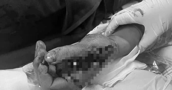 Pháo nổ trên tay, chàng trai trẻ chấn thương nghiêm trọng