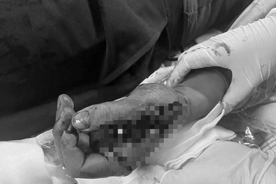 Pháo phát nổ trên tay, chàng trai trẻ chấn thương nghiêm trọng Pháo phát nổ trên tay, chàng trai trẻ chấn thương nghiêm trọng
