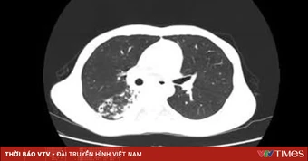 Phát hiện ca mắc lao phối hợp phức tạp nhờ nội soi
