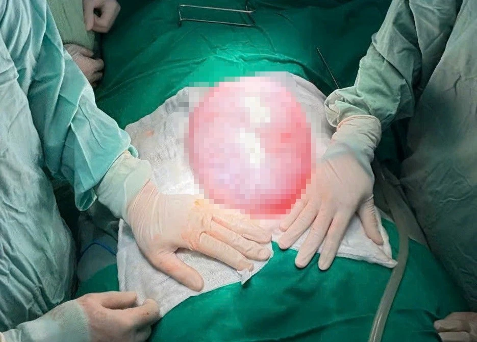 Phát hiện khối u gần 4kg trong bụng bé gái 13 tuổi Phát hiện khối u gần 4kg trong bụng bé gái 13 tuổi