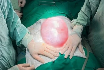 Phát hiện khối u gần 4kg trong bụng bé gái 13 tuổi