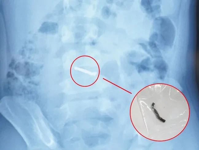 Phát hiện nhiều viên nam châm nhỏ trong ruột bé trai 5 tuổi Phát hiện nhiều viên nam châm nhỏ trong ruột bé trai 5 tuổi