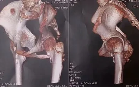 Phát hiện sớm hội chứng "người hóa đá" thể hiếm ở bé gái 12 tuổi Phát hiện sớm hội chứng "người hóa đá" thể hiếm ở bé gái 12 tuổi