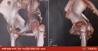 Phát hiện sớm hội chứng "người hóa đá" thể hiếm ở bé gái 12 tuổi
