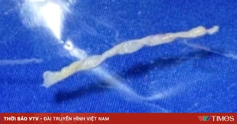 Phát hiện trường hợp nhiễm ấu trùng sán nhái hiếm gặp