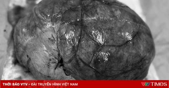 Phát hiện u buồng trứng 36cm ở bệnh nhân 23 tuổi