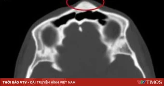 Phát hiện u xương sọ từ khối nhọt vùng đầu