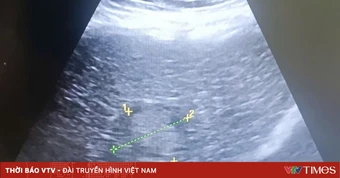 Phát hiện ung thư gan muộn vì không khám định kỳ