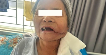Phát hiện ung thư từ một vết loét ở miệng