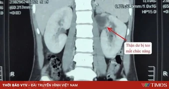 Phẫu thuật thành công dị tật hiếm: Thận đôi kèm niệu quản giãn lớn