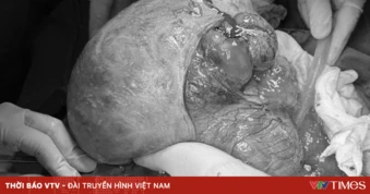 Phẫu thuật thành công khối u nặng 6kg