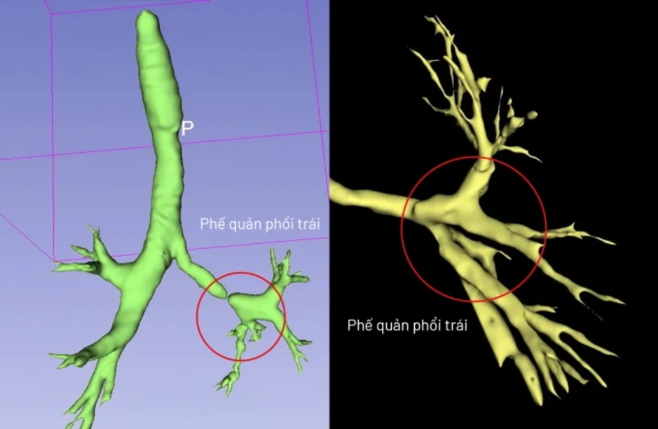 Phế quản hẹp khít như sợi chỉ do di chứng lao phổi - Báo TinVina Phế quản hẹp khít như sợi chỉ do di chứng lao phổi - Báo TinVina