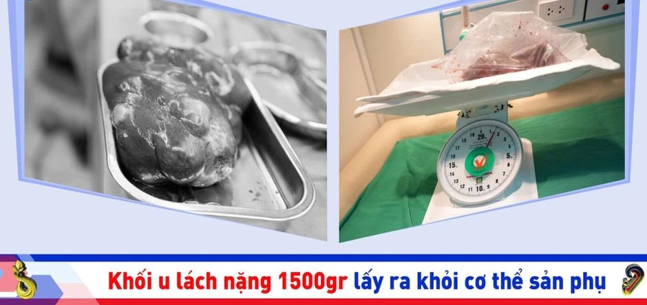 Phối hợp liên viện xử trí lấy thai an toàn cho sản phụ có khối u lách khổng lồ 1,5kg Phối hợp liên viện xử trí lấy thai an toàn cho sản phụ có khối u lách khổng lồ 1,5kg