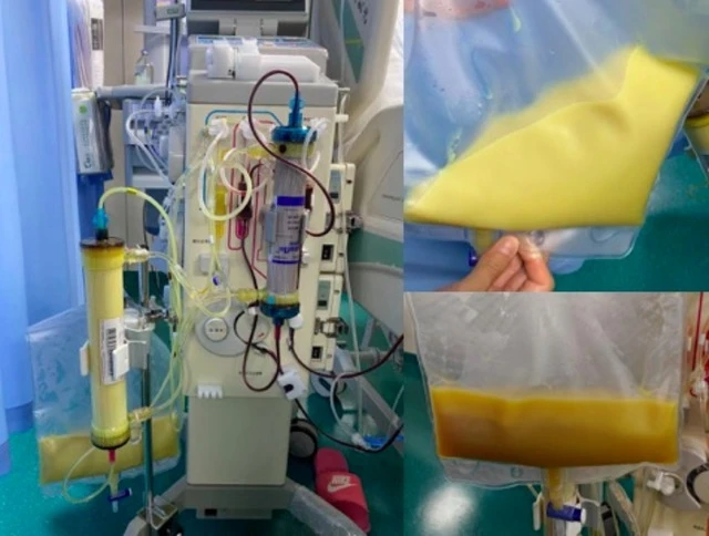 Rút ra 2 lít máu trắng đục như sữa từ cô bé 12 tuổi, bố mẹ oà khóc: "Tưởng cháu đau bụng vì ăn đồ không sạch" Rút ra 2 lít máu trắng đục như sữa từ cô bé 12 tuổi, bố mẹ oà khóc: "Tưởng cháu đau bụng vì ăn đồ không sạch"