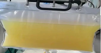 Rút ra 2 lít máu trắng đục như sữa từ cô bé 12 tuổi, bố mẹ oà khóc: "Tưởng cháu đau bụng vì ăn đồ không sạch"