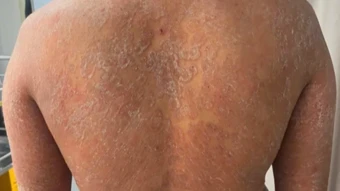 Sai lầm trong điều trị nấm da, bệnh da bùng phát khắp cơ thể