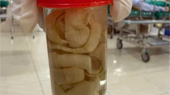 Sán dài 1,2 m ký sinh trong bụng người đàn ông