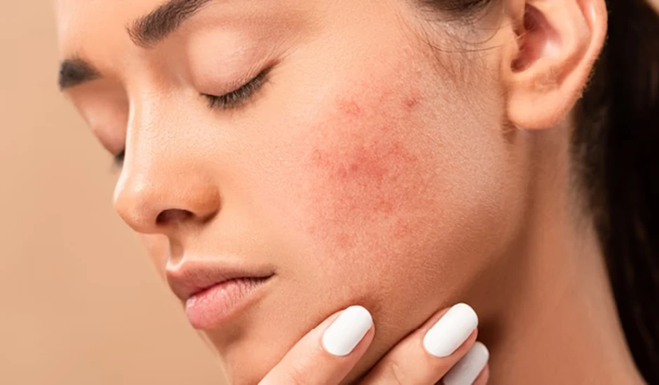 Sau khi hết mụn, nhiều người Việt vẫn mắc 5 sai lầm khiến mụn quay trở lại Sau khi hết mụn, nhiều người Việt vẫn mắc 5 sai lầm khiến mụn quay trở lại