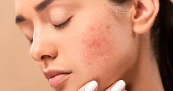Sau khi hết mụn, nhiều người Việt vẫn mắc 5 sai lầm khiến mụn quay trở lại