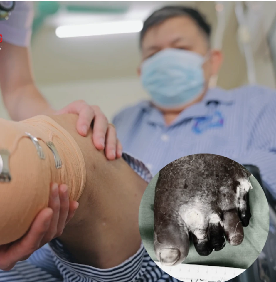 Sơ suất khiến người đàn ông phải cắt cụt chân vì ngâm nước trà xanh nóng Sơ suất khiến người đàn ông phải cắt cụt chân vì ngâm nước trà xanh nóng