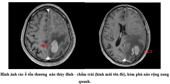Sốc khi phát hiện ung thư di căn não chỉ sau 2 dấu hiệu Sốc khi phát hiện ung thư di căn não chỉ sau 2 dấu hiệu