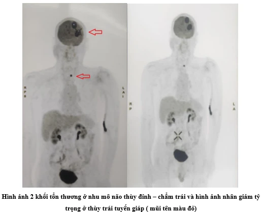 Sốc khi phát hiện ung thư di căn não chỉ sau 2 dấu hiệu Sốc khi phát hiện ung thư di căn não chỉ sau 2 dấu hiệu