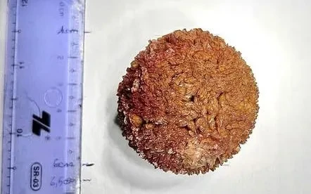 Sỏi niệu quản gần 100g nằm trong cơ thể suốt 20 năm Sỏi niệu quản gần 100g nằm trong cơ thể suốt 20 năm