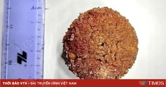 Sỏi niệu quản gần 100g nằm trong cơ thể suốt 20 năm