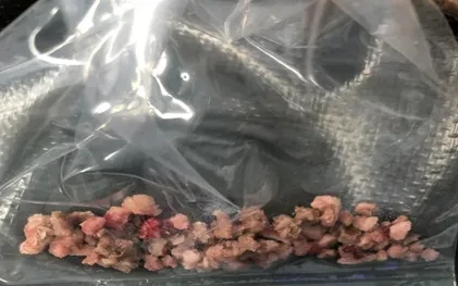 Sỏi tiết niệu âm thầm phá hủy chức năng thận như thế nào? Sỏi tiết niệu âm thầm phá hủy chức năng thận như thế nào?