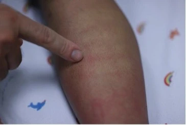 Sốt xuất huyết Dengue và những dự định dở dang bên giường bệnh Sốt xuất huyết Dengue và những dự định dở dang bên giường bệnh