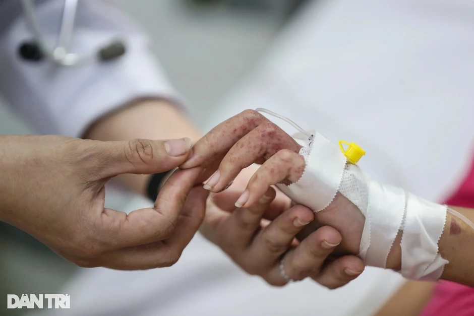 Sốt xuất huyết tăng mạnh, chuyên gia chỉ nhiều hiểu lầm phổ biến