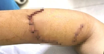 Sức khỏe nữ sinh lớp 9 bị bạn dùng dao tấn công gây đa thương tích ở Đắk Lắk