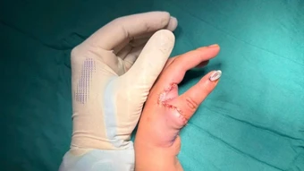 Tái tạo ngón cái cho trẻ bằng chính ngón trỏ, mở ra cơ hội mới cho trẻ mắc dị tật bẩm sinh