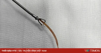 Tăm tre đâm thủng đại tràng sau bữa ăn