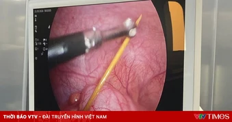 Tăm tre đâm thủng ruột, được phát hiện trong ca mổ ruột thừa