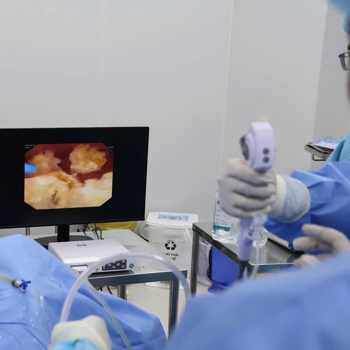 Tán sỏi thận bằng ống soi mềm giúp cụ bà 72 tuổi hồi phục thần kỳ Tán sỏi thận bằng ống soi mềm giúp cụ bà 72 tuổi hồi phục thần kỳ