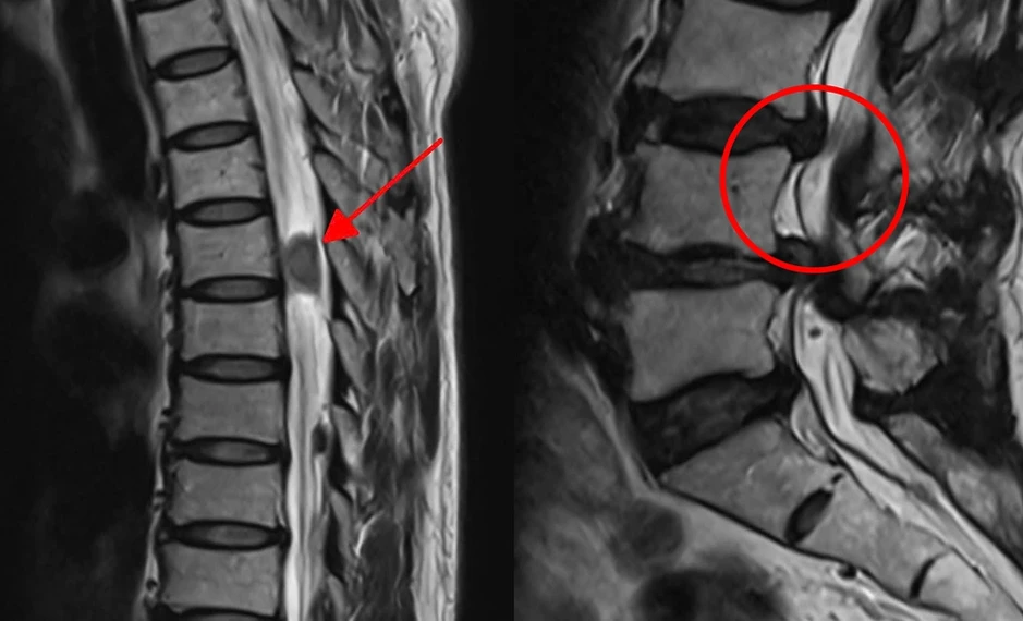 Tắt máy tạo nhịp tim để chụp MRI, mổ cột sống cho người phụ nữ - Báo TinVina Tắt máy tạo nhịp tim để chụp MRI, mổ cột sống cho người phụ nữ - Báo TinVina