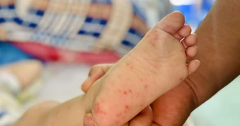 Tay chân miệng ở TP.HCM tăng cao, thêm 2 ca tử vong