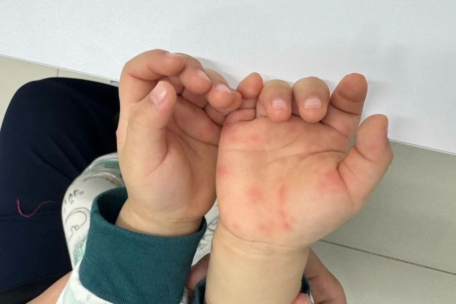 Tay chân miệng tăng nhanh, Bộ Y tế khuyến cáo cho trẻ nghỉ học khi mắc bệnh Tay chân miệng tăng nhanh, Bộ Y tế khuyến cáo cho trẻ nghỉ học khi mắc bệnh