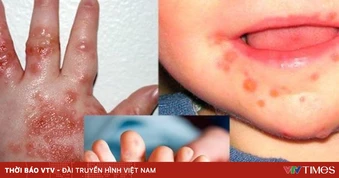 Tay chân miệng vào mùa: Trẻ có thể mắc nhiều lần, dễ chuyển nặng nếu chủ quan