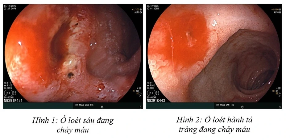 Tháng cuối năm, nhiều người trẻ đi cấp cứu vì xuất huyết dạ dày