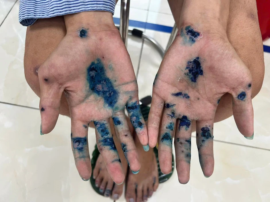 Thanh niên 18 tuổi chân tay hóa mủ do căn bệnh bị lãng quên Thanh niên 18 tuổi chân tay hóa mủ do căn bệnh bị lãng quên