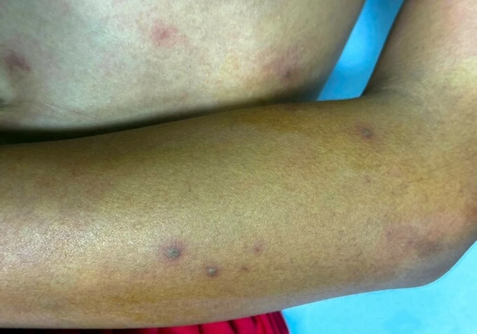 Thiếu niên bị ong vò vẽ đốt hơn 50 vết Thiếu niên bị ong vò vẽ đốt hơn 50 vết